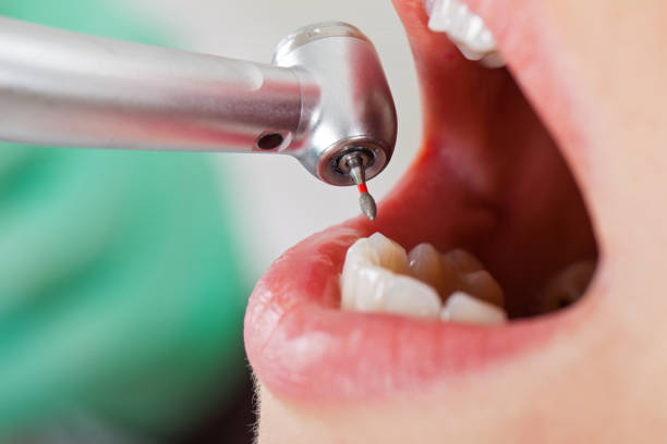 Best Emergency Dental Care for Broken or Chipped Teeth in Ferndale, MI